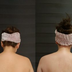 Фотоотчёт с результатами массажа шейно-воротниковой зоны