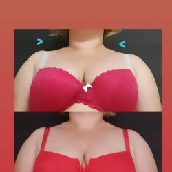 Фотоотчёт с результатами массажа шейно-воротниковой зоны