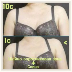 Фотоотчёт с результатами массажа шейно-воротниковой зоны и спины