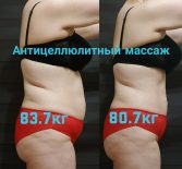 Фотоотчёт с результатами антицеллюлитного массажа