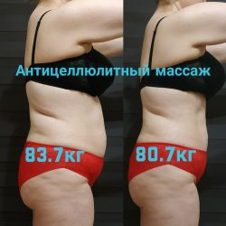Фотоотчёт с результатами антицеллюлитного массажа