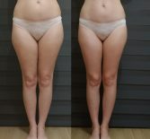Фотоотчёт с результатами антицеллюлитного массажа