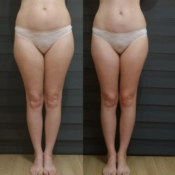 Фотоотчёт с результатами антицеллюлитного массажа