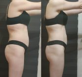 Фотоотчет с результатами антицеллюлитного массажа