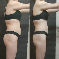 Фотоотчет с результатами антицеллюлитного массажа