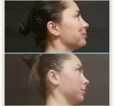 Фотоотчёт с результатами скульптурного массажа лица