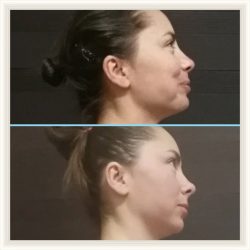 Фотоотчёт с результатами скульптурного массажа лица