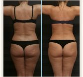 Фотоотчёт с результатами антицеллюлитного массажа