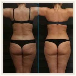 Фотоотчёт с результатами антицеллюлитного массажа