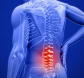 Спондилоартроз