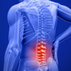 Спондилоартроз