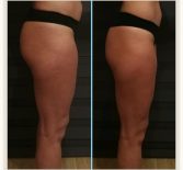 Фотоотчёт с результатами антицеллюлитного массажа