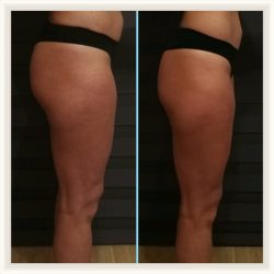 Фотоотчёт с результатами антицеллюлитного массажа