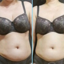 Фотоотчёт с результатами массажа шейно-воротниковой зоны и спины