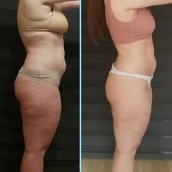 Фотоотчёт с результатами антицеллюлитного массажа