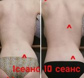 Фотоотчёт с результатами массажа спины