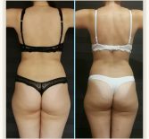 Фотоотчёт с результатами антицеллюлитного массажа