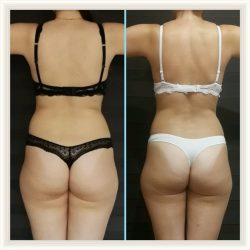 Фотоотчёт с результатами антицеллюлитного массажа