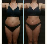 Фотоотчёт с результатами антицеллюлитного массажа