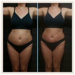 Фотоотчёт с результатами антицеллюлитного массажа