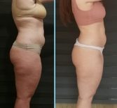 Фотоотчёт с результатами антицеллюлитного массажа