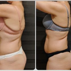 Фотоотчёт с результатами антицеллюлитного массажа