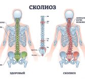 Сколиоз у взрослых: можно ли выровнять спину, если вы уже выросли?