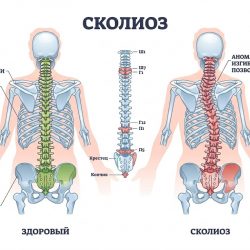 Сколиоз у взрослых: можно ли выровнять спину, если вы уже выросли?