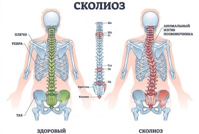 Сколиоз у взрослых: можно ли выровнять спину, если вы уже выросли?