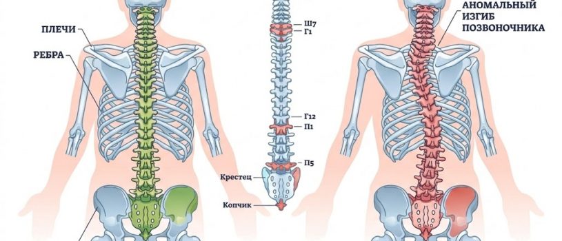 Сколиоз у взрослых: можно ли выровнять спину, если вы уже выросли?